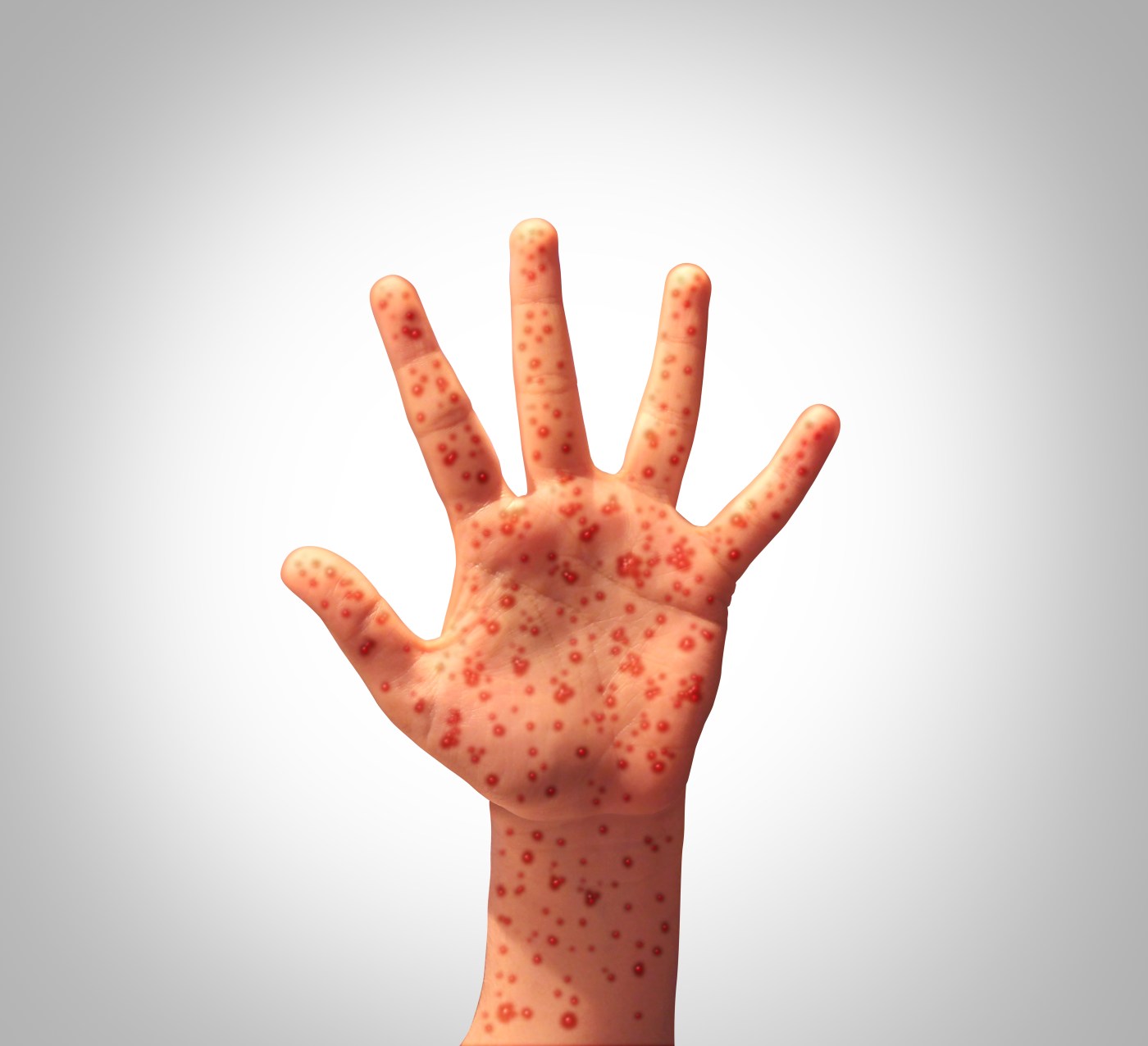 Editorial: Vaccine hesitant? Pueblo measles case is reason to revisit MMR risks